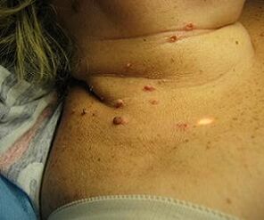 humant papillomavirus på halsen