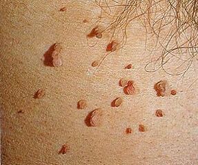 humant papillomavirus på huden
