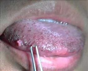humant papillomavirus på tungen