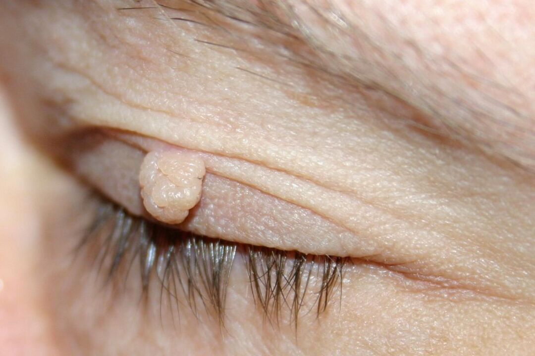 symptomer på papilloma på øyelokket