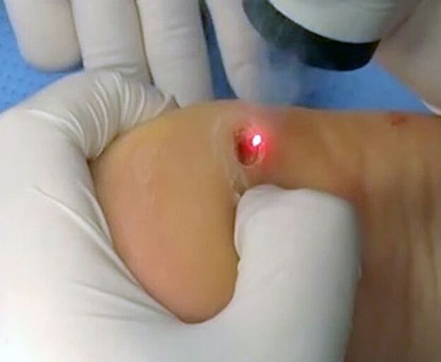 Prosedyren for å fjerne vorter på hælen ved hjelp av en laser