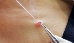 fjerning av papillomer på kroppen med en laser