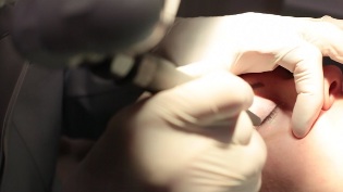 Laserfjerning av papilloma på øyelokket